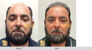 Riverside CA FUE Hair Restoration - Before and After Results for 51-Year-Old Male