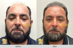 Riverside CA FUE Hair Restoration - Before and After Results for 51-Year-Old Male