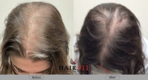 Best Hair Transplant for Women in Riverside – Hair911Pros Before & After