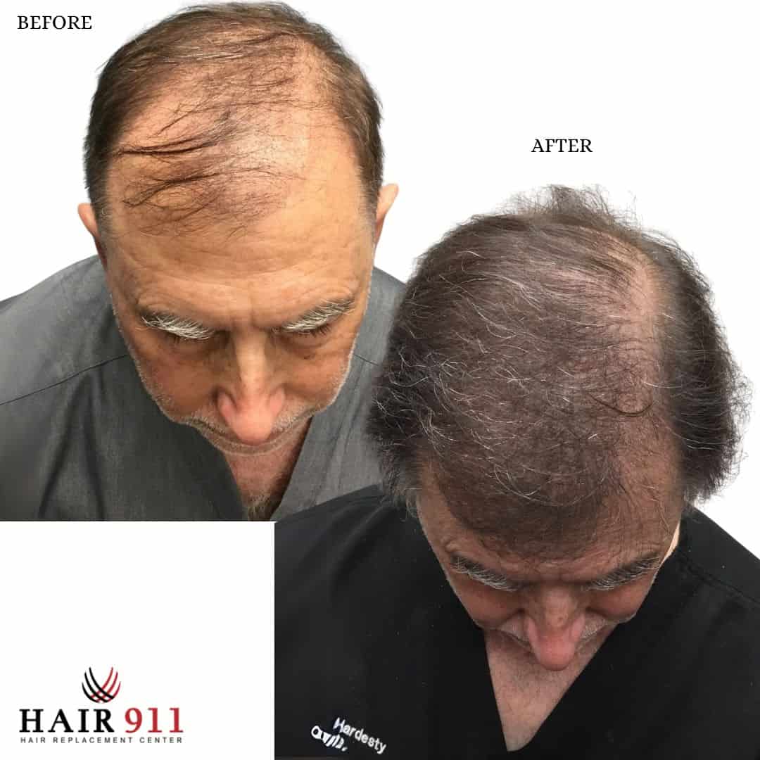 Before & After FUE Hair Transplant in Riverside & Redlands – Male Hair Restoration for Balding – Hair911Pros.com